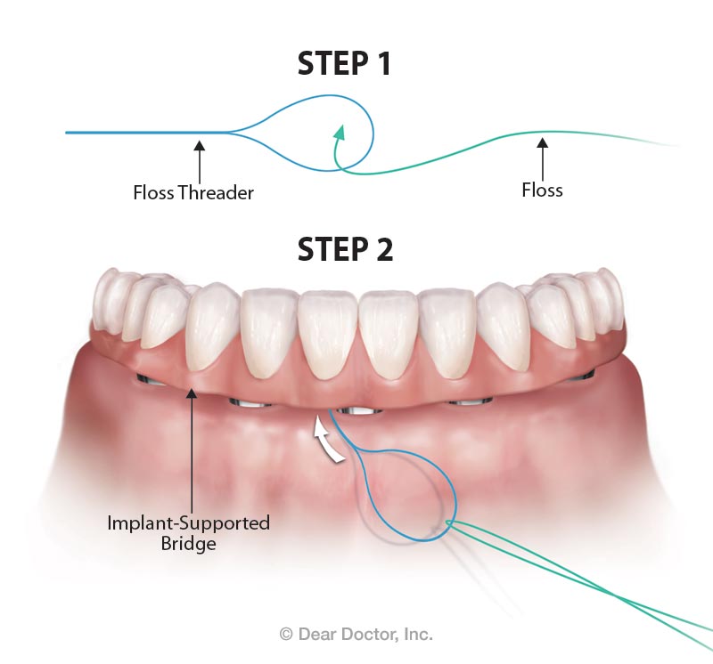 Oral Hygiene For Fixed Bridgework Flossing Around Dental Implants