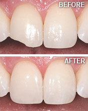 How Dental Bonding Repairs Damaged & Chipped Teeth