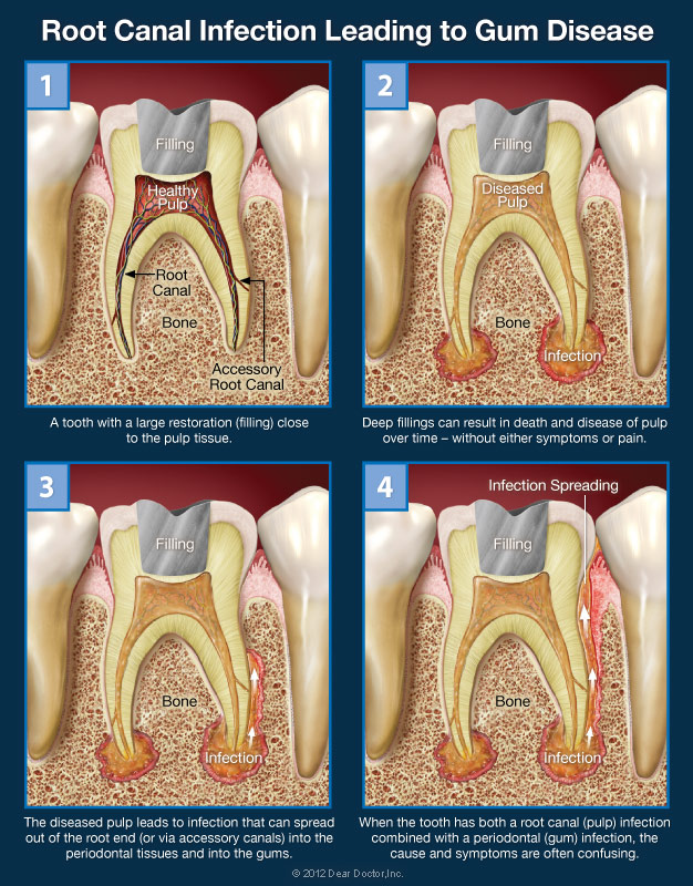 combined-root-canal-and-gum-problems-stratford-orthodontics