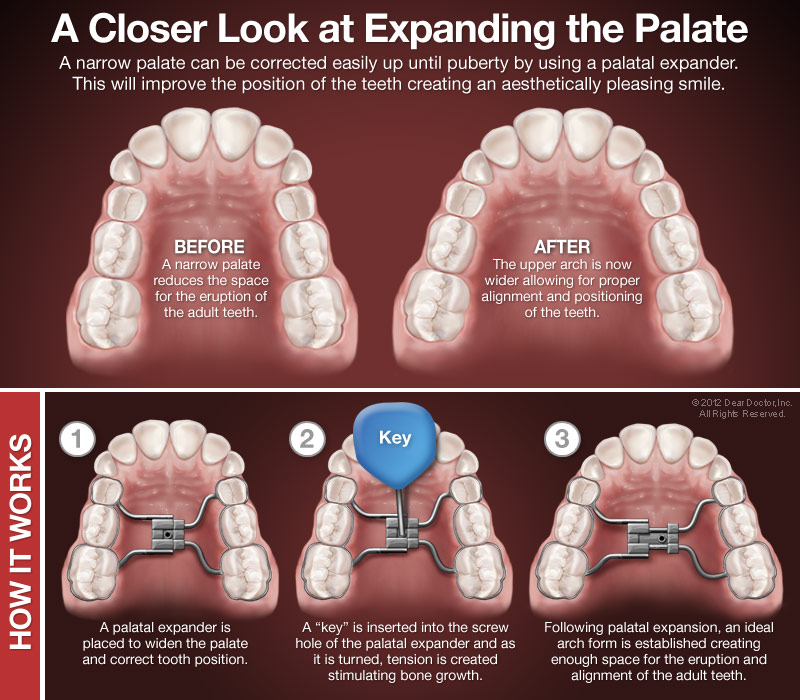 Palatal Expanders, Summe Orthodontics
