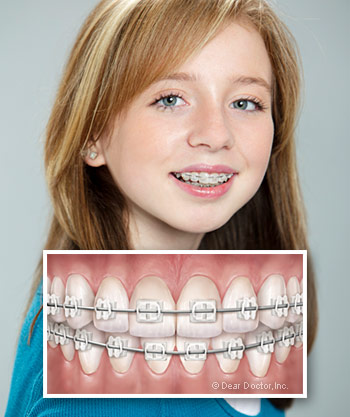 http://www.deardoctor.com/images/webcontent/types-of-braces/girl-with-ceramic-braces.jpg