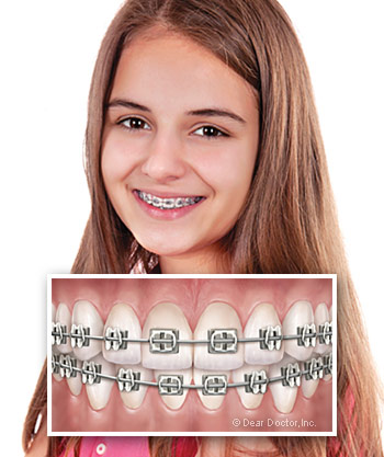 Metal Braces  familyorthodontics