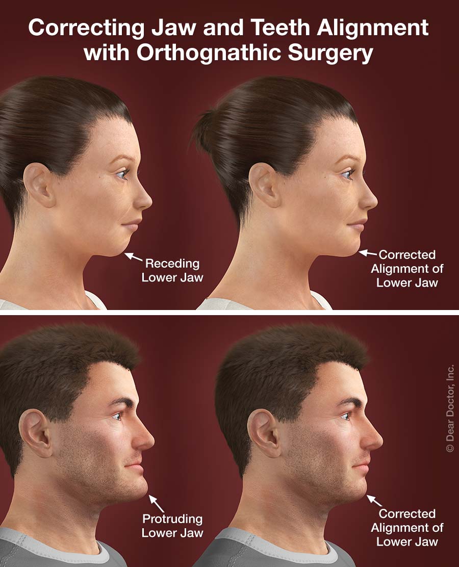 Is jaw surgery serious?