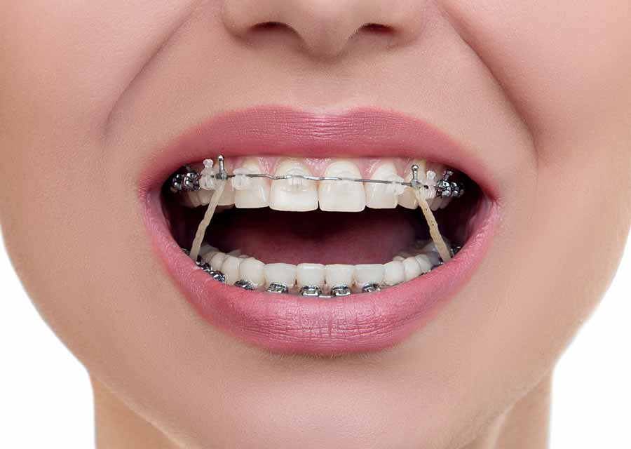 Elastic (Rubber Bands) in Orthodontic Treatment, East Lyme Orthodontics,  Inc.