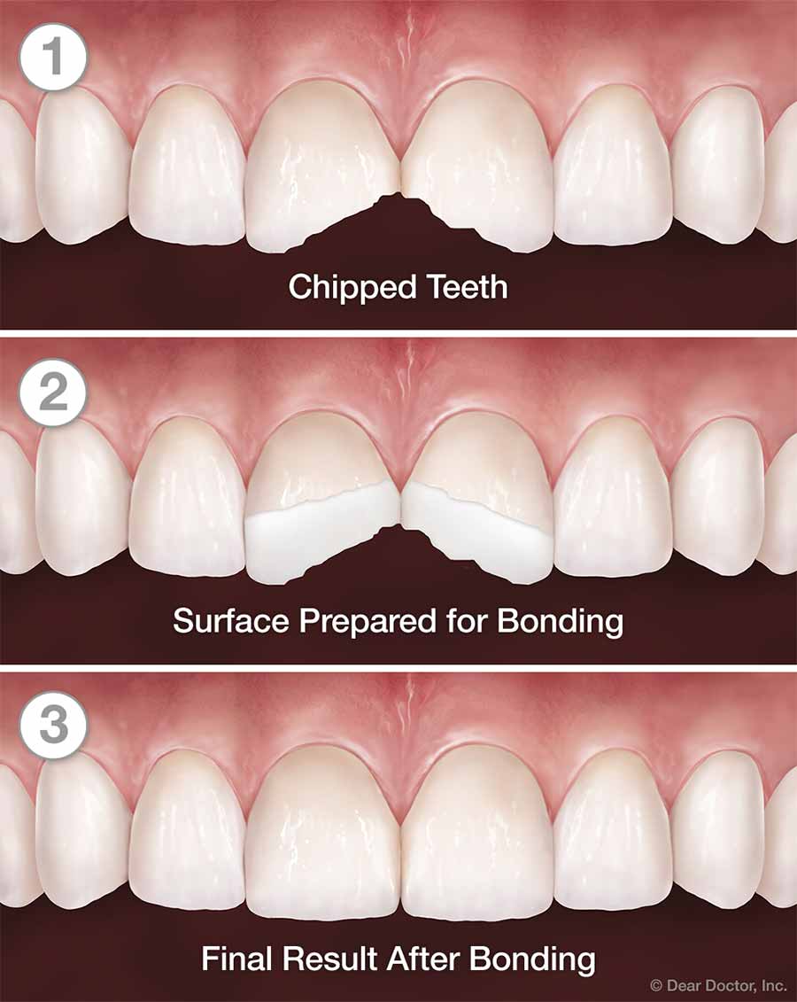 Tooth Bonding, Stanley R. Beard, D.M.D., FAGD