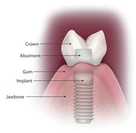 Dental Implant Success Rate