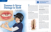 Trauma & Nerve Damage to Teeth 