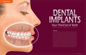 Dental Implants — Your Third Set of Teeth