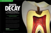 What is Tooth Decay? — And How to Prevent It!