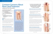 Common Concerns About Root Canal Treatment