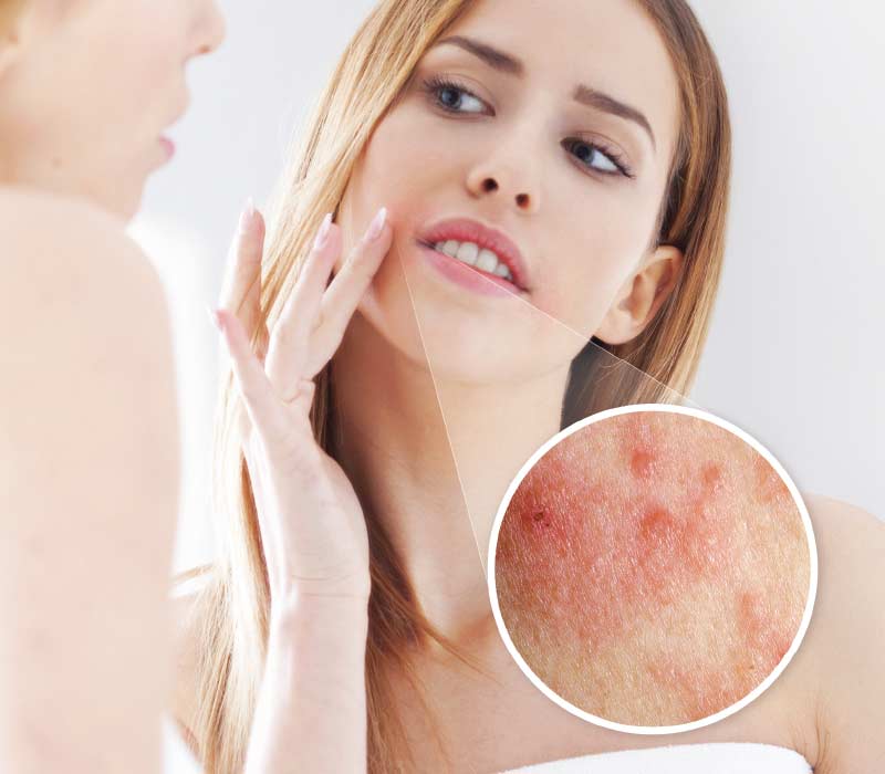 Peri oral Dermatitis Rash Around The Mouth