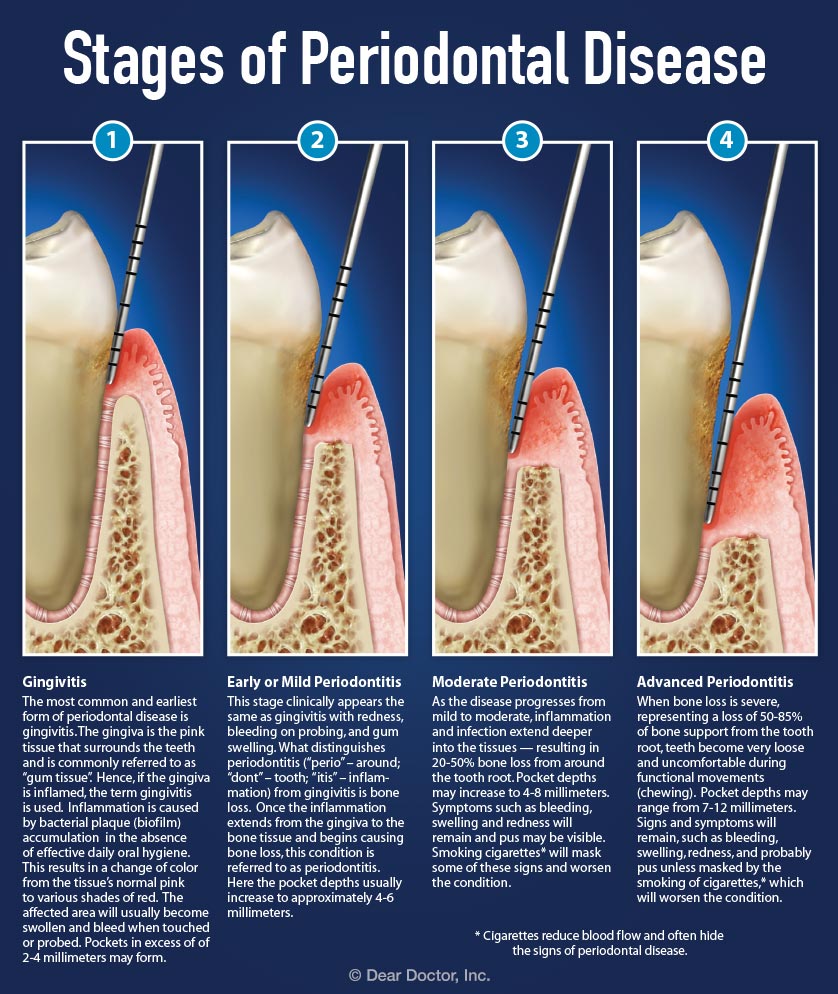 Stages Of Periodontal Disease 