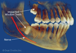 reverse impacted wisdom tooth