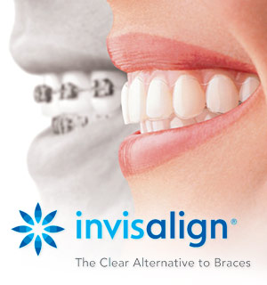 Invisalign Clear Braces Canandaigua, Orthodontist Geneva, Victor NY