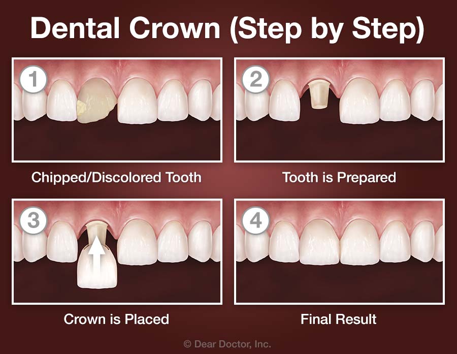 Crowns Bridgework Dr Shelley Lyle Dr Mary Davis And Dr Ella 