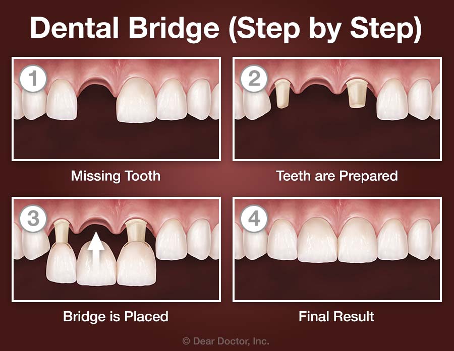 Dental Bridge Abutment