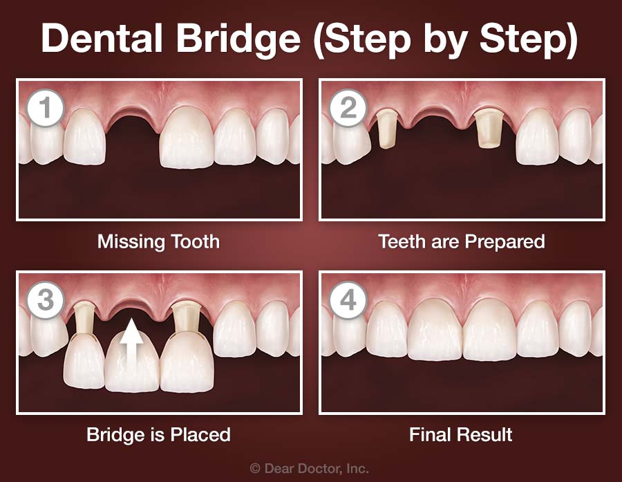 Dental Bridges Family And Children s Dentistry Atlanta Georgia