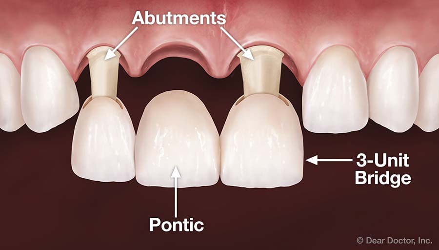 Dental Bridges Hall Taylor Family Cosmetic Dentistry Mobile Alabama