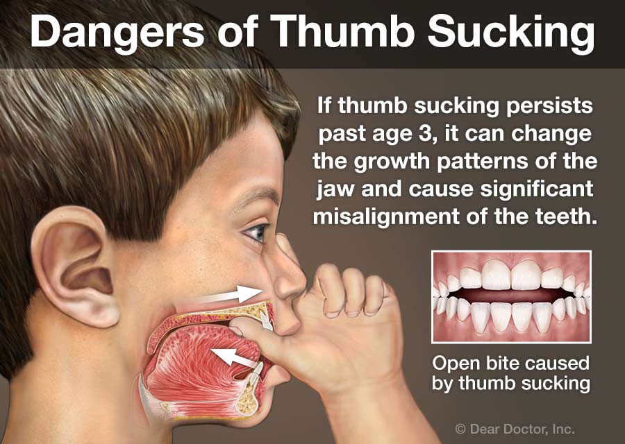 Early Orthodontic Treatment Family And Children s Dentistry Atlanta 