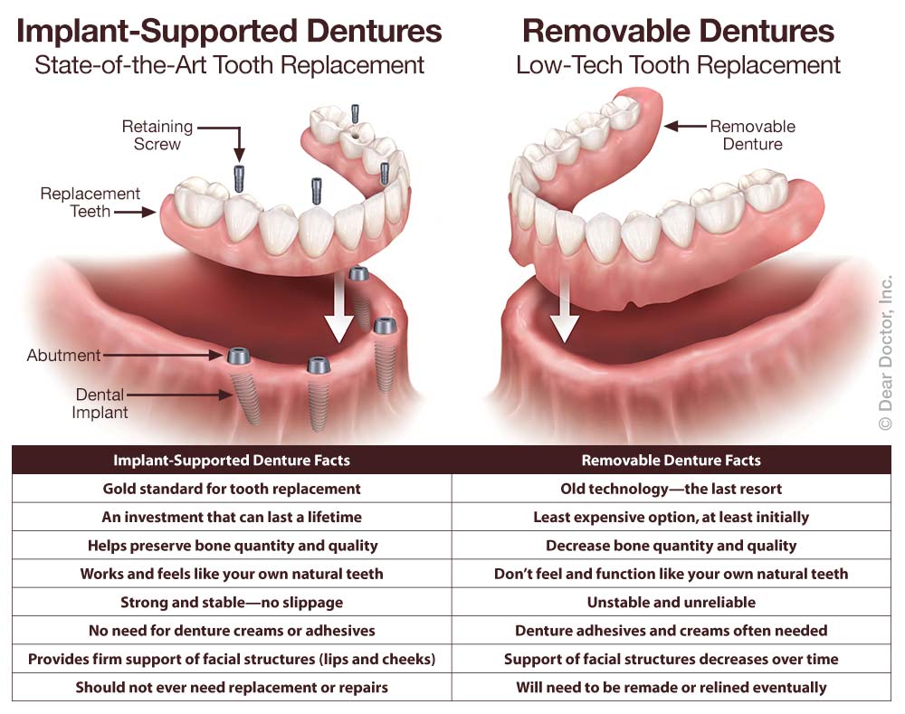 Fixed Dentures Family Dental Associates Margate Florida