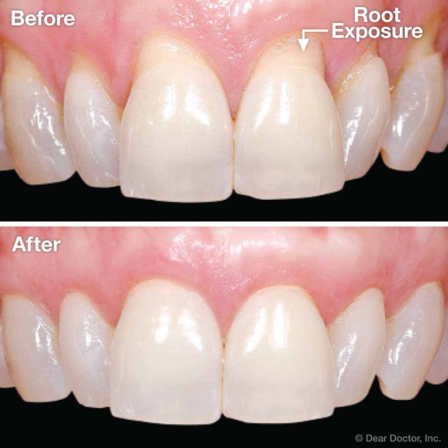 Gingival Gum Grafting Coastal Periodontics Implant Dentistry 