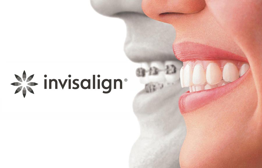 Invisalign ® First clear aligners.