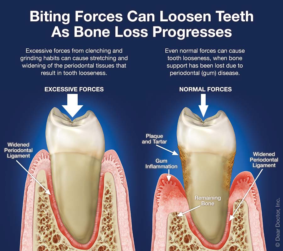 Loose Teeth And Bite Problems Woodcreek Dental Care