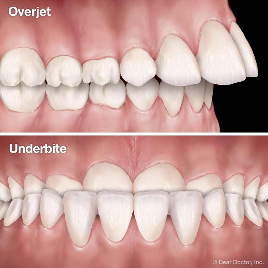 Orthodontic Treatment for Overjet (Overbite) - Rubber Bands 