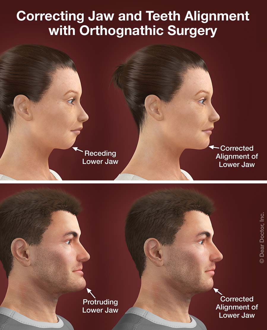 Orthognathic Surgery Kalaskey Orthodontics Charleston West Virginia