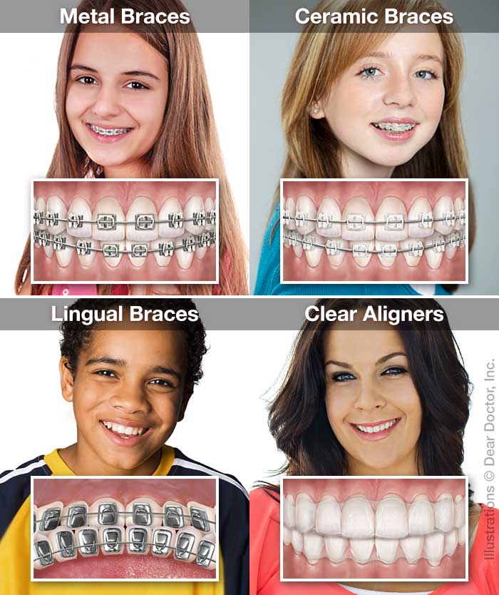 Benefits of Traditional Braces - Dentist in Springfield, MO