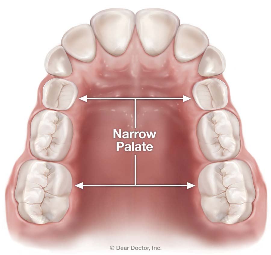 Palatal Expanders, Weisner Orthodontics