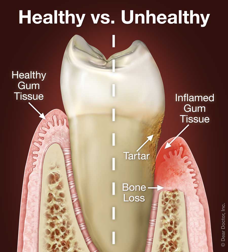 Periodontal Gum Disease Snowmass Village Dental Snowmass Village 