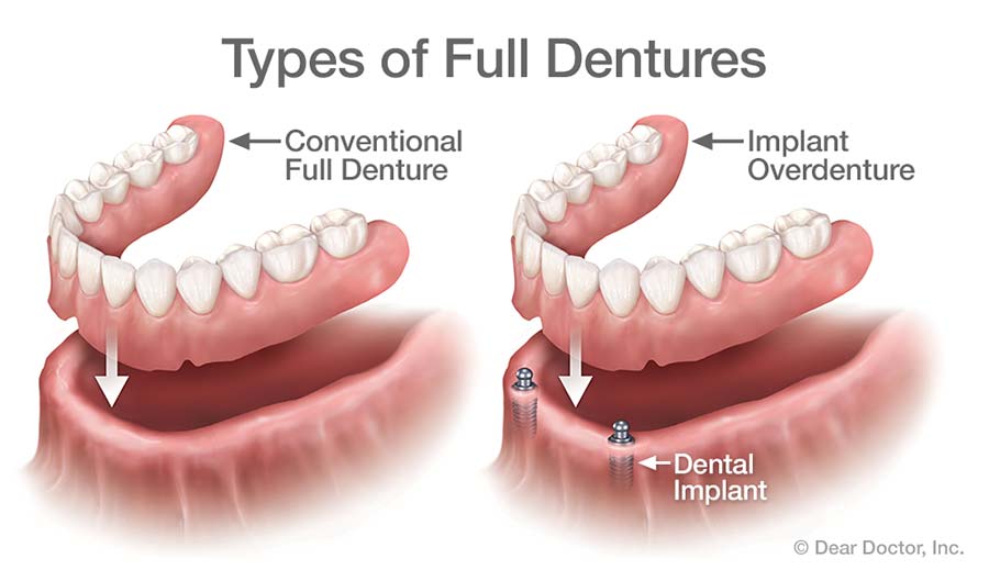 Immediate Dentures Steps