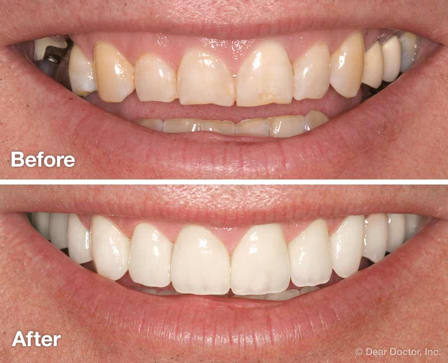 Dental Bonding Before and After Photos, Smile Makeover