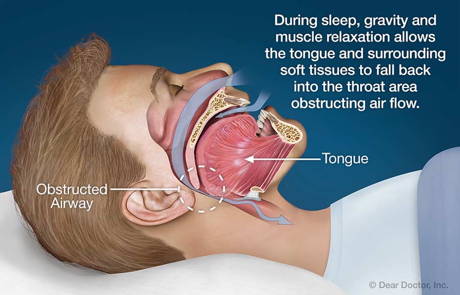 Snoring And Sleep Apnea Doctors Morris Taylor LTD Portsmouth VA