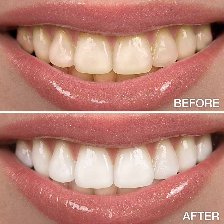 teeth translucent after whitening