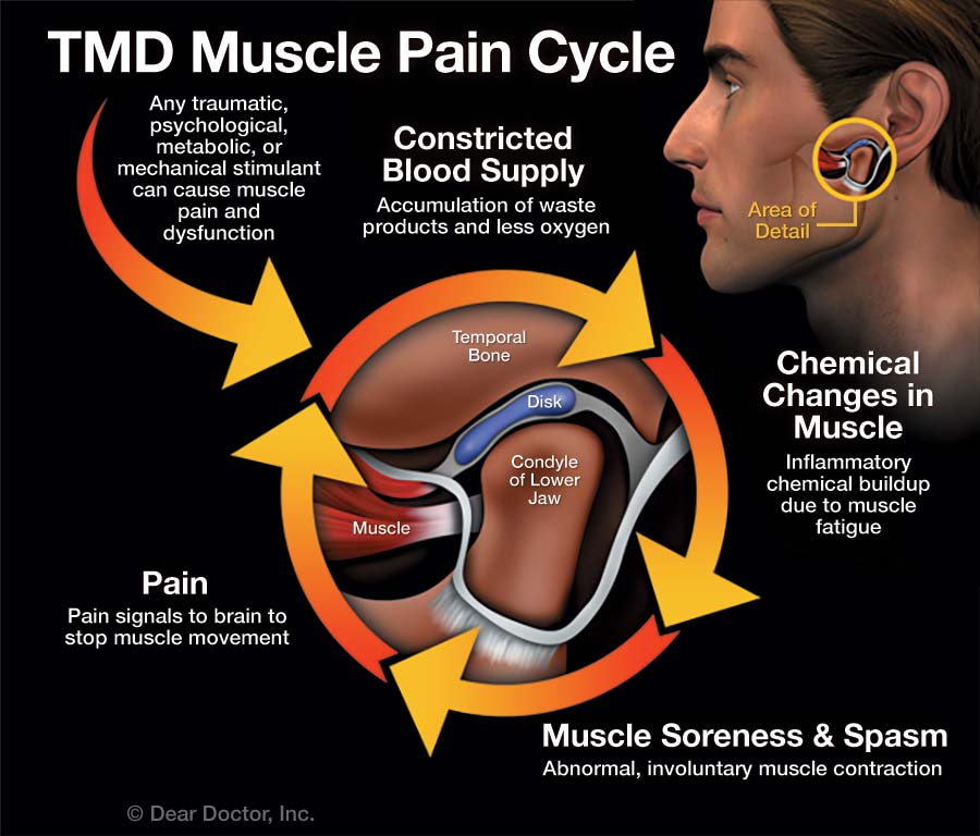 TMJ Disorders Polished Dental Bismarck ND