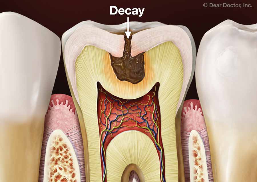 Tooth Decay Prevention Dr George P Cerniglia Metairie Louisiana