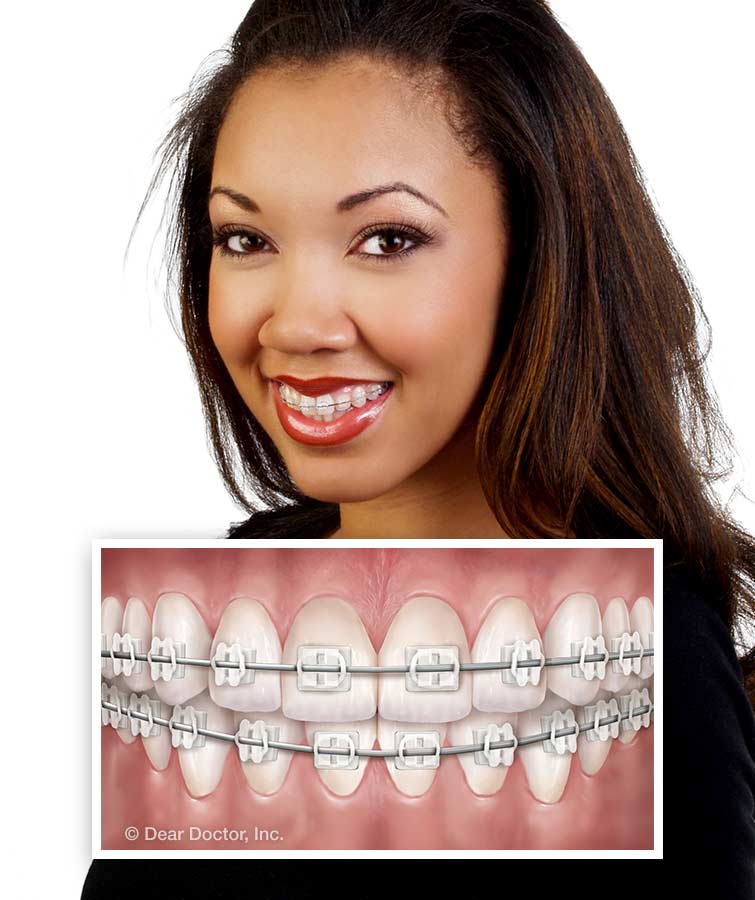 The Different Types of Dental Braces