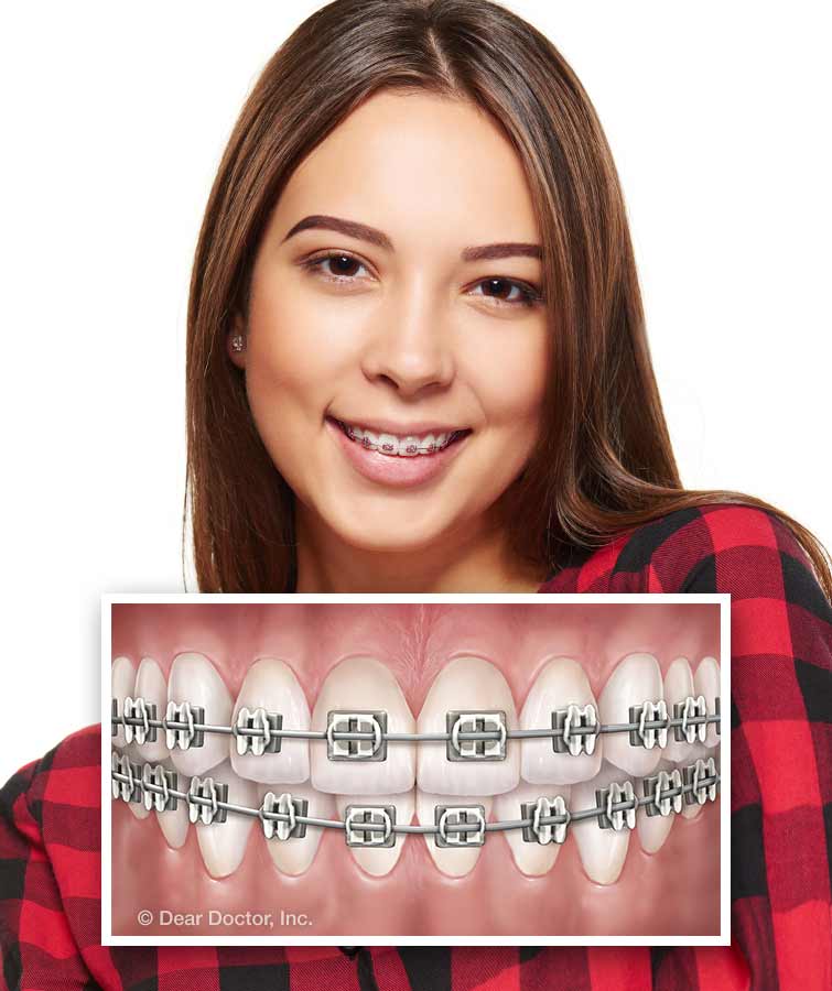 Types of Braces, Kashner Orthodontics