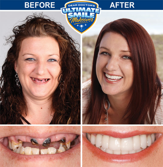 Cosmetic smile makeovers