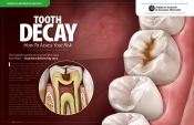 Tooth Decay — How To Assess Your Risk