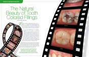 The Natural Beauty of Tooth Colored Fillings
